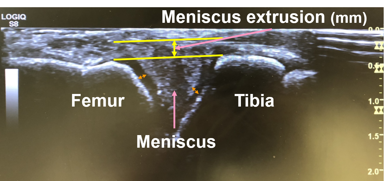meniscus extrusion image