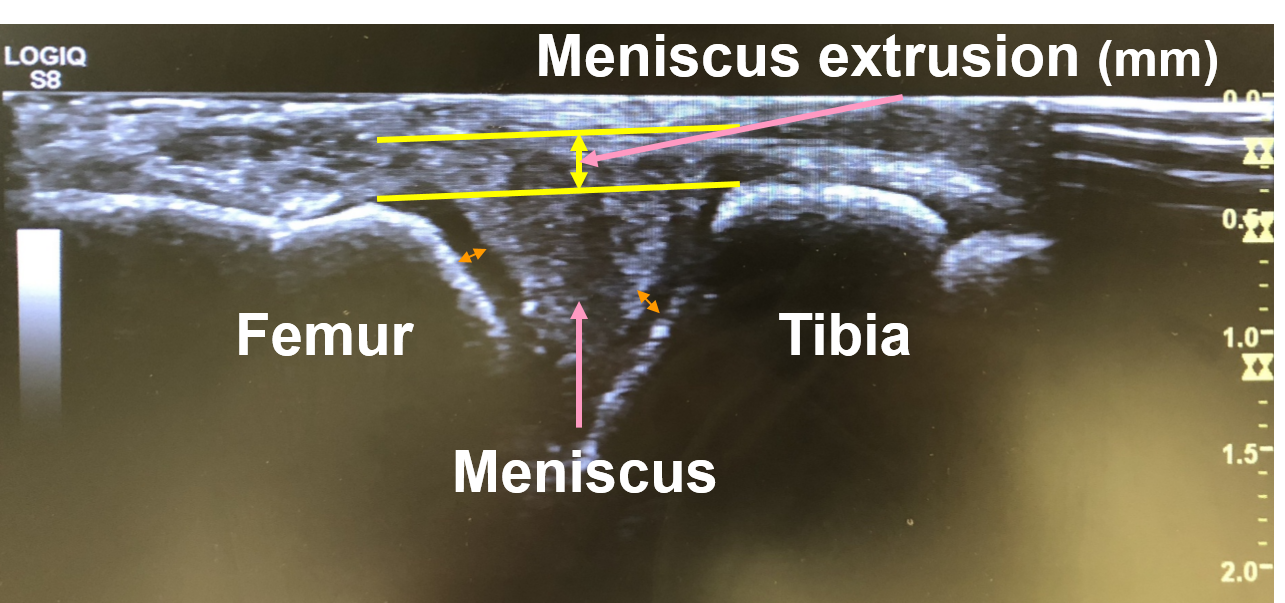 Meniscus Extrusion