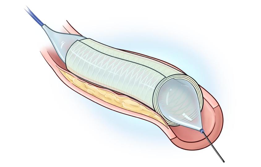 Biocarpet - A diagram of Biocarpet Biocarpet