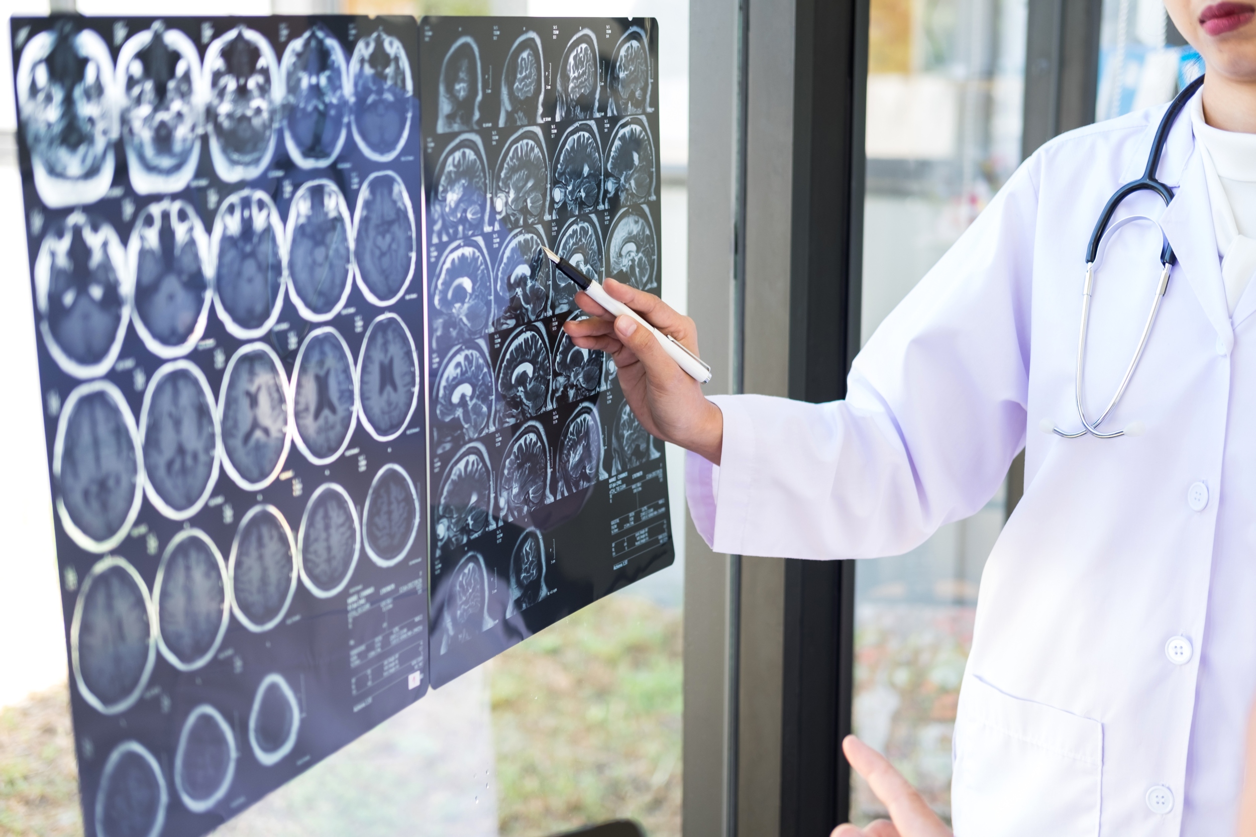 Doctor looking at brain x-ray films