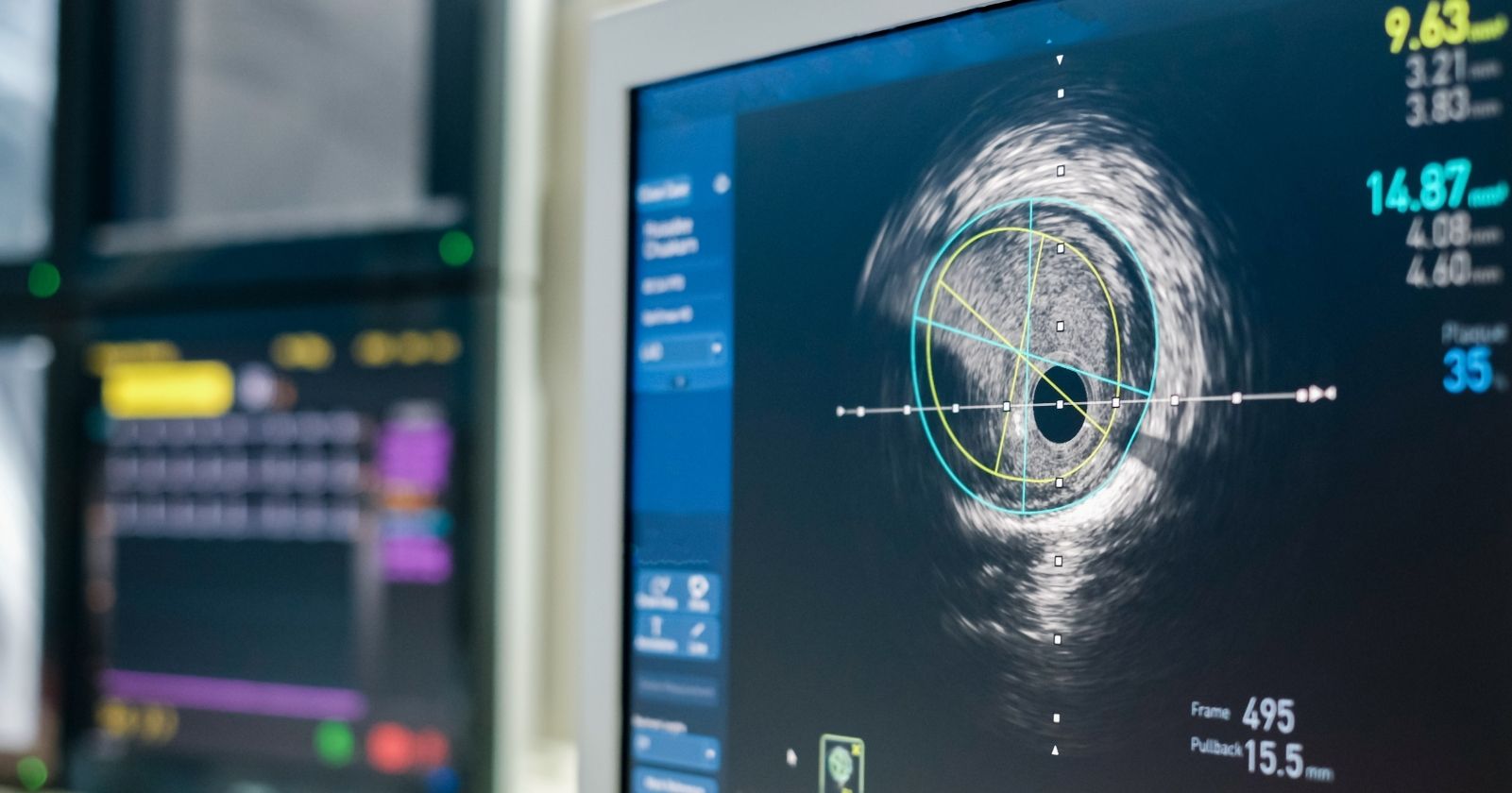 stock photo of an intravascular ultrasound image displayed on a computer.